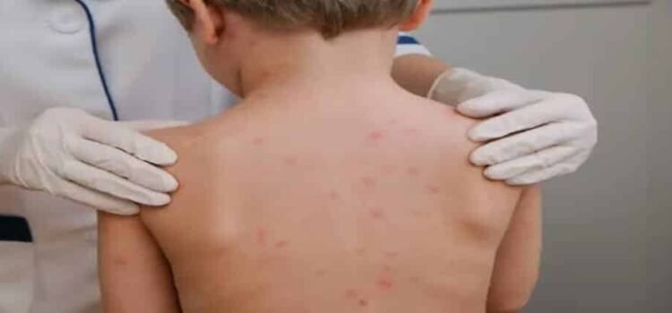 Confirman primeros casos de sarampión en Michoacán
