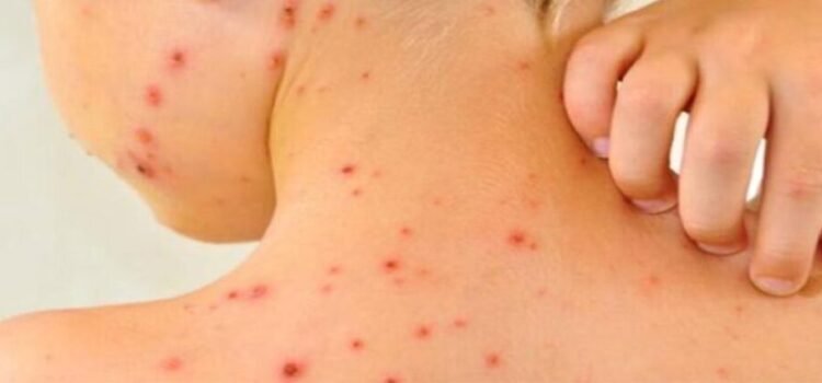 Aumentan casos de sarampión en Michoacán; van 22 enfermos y es la sexta a nivel nacional