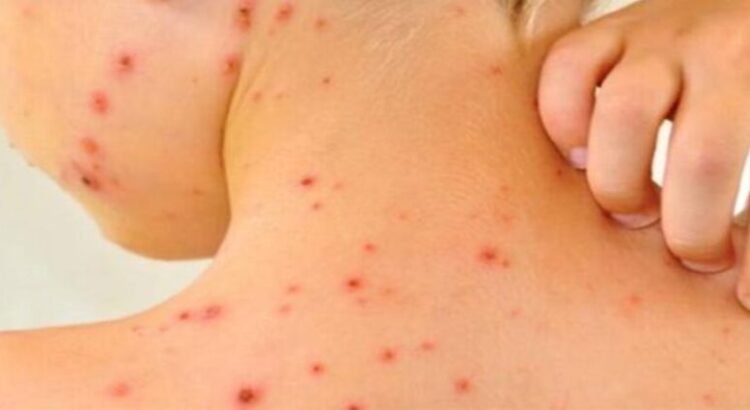 Aumentan casos de sarampión en Michoacán; van 22 enfermos y es la sexta a nivel nacional