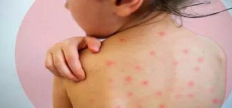 Rebasa Michoacán los 200 casos de sarampión