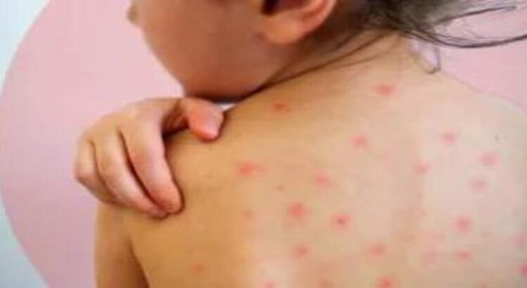 Rebasa Michoacán los 200 casos de sarampión Rebasa Michoacán los 200 casos de sarampión